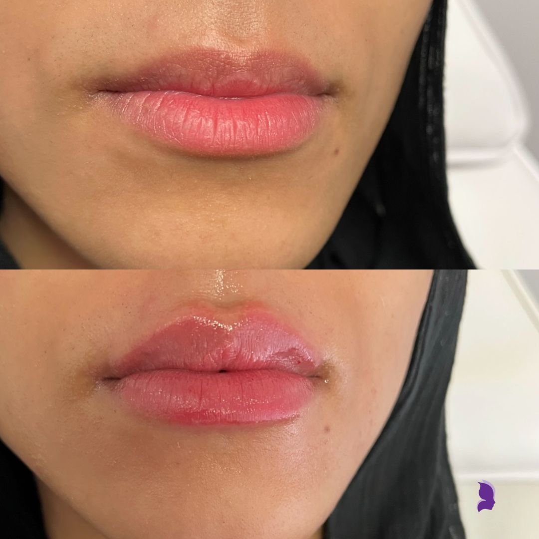 Sarahs Injectable before and afters (10)