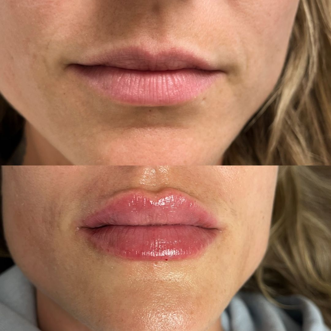 Sarahs Injectable before and afters (11)