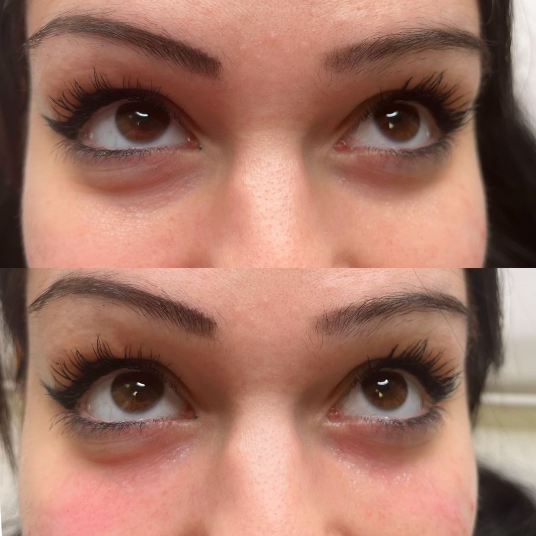 Sarahs Injectable before and afters (12)