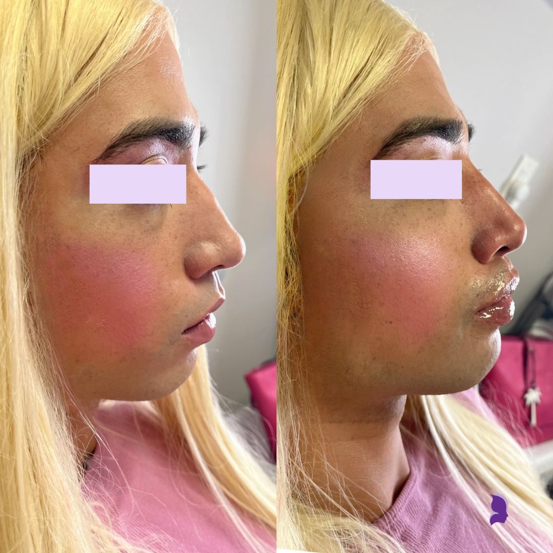 Sarahs Injectable before and afters (13)