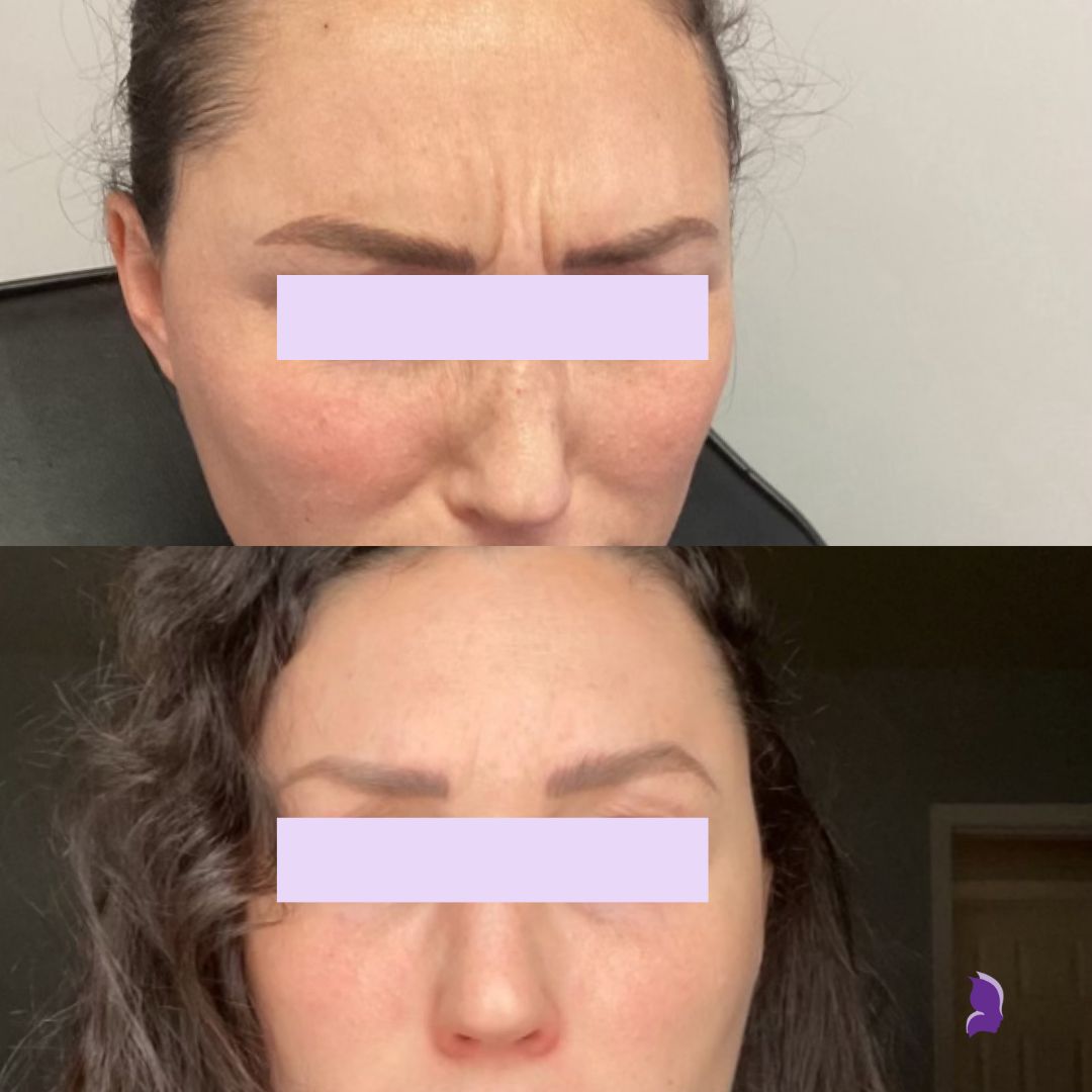 Sarahs Injectable before and afters (15)